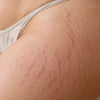 Stretch marks: why they appear and how to reduce their visibility